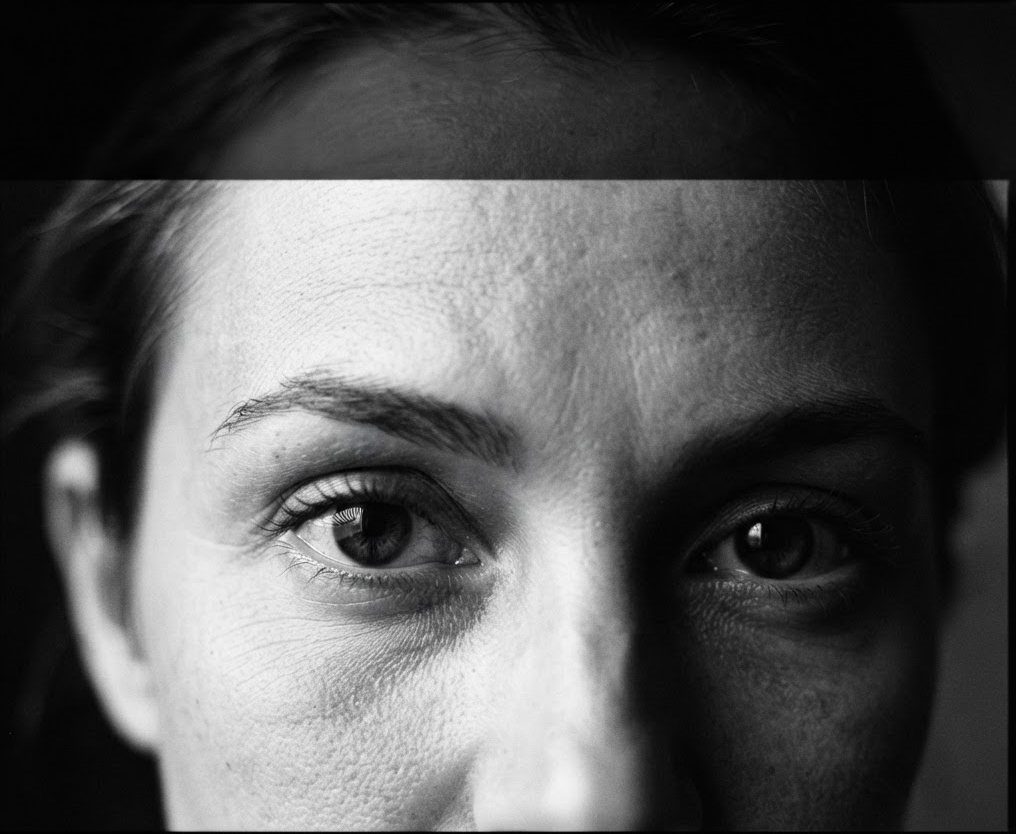 Eyelid surgery