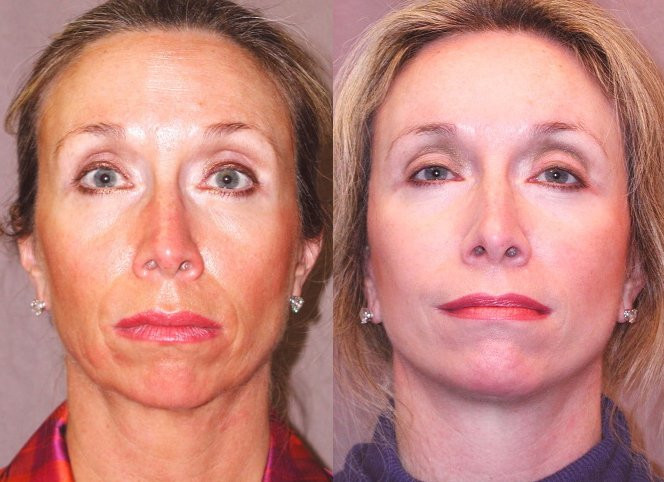 Dr. Kirwan patient result. Combined facial surgery supplied with facelift, endoscopic brow and upper/lower eyelid treatment context. Treatment sequence and follow-up interval are not established. Complete supplied comparison; before left, after right.