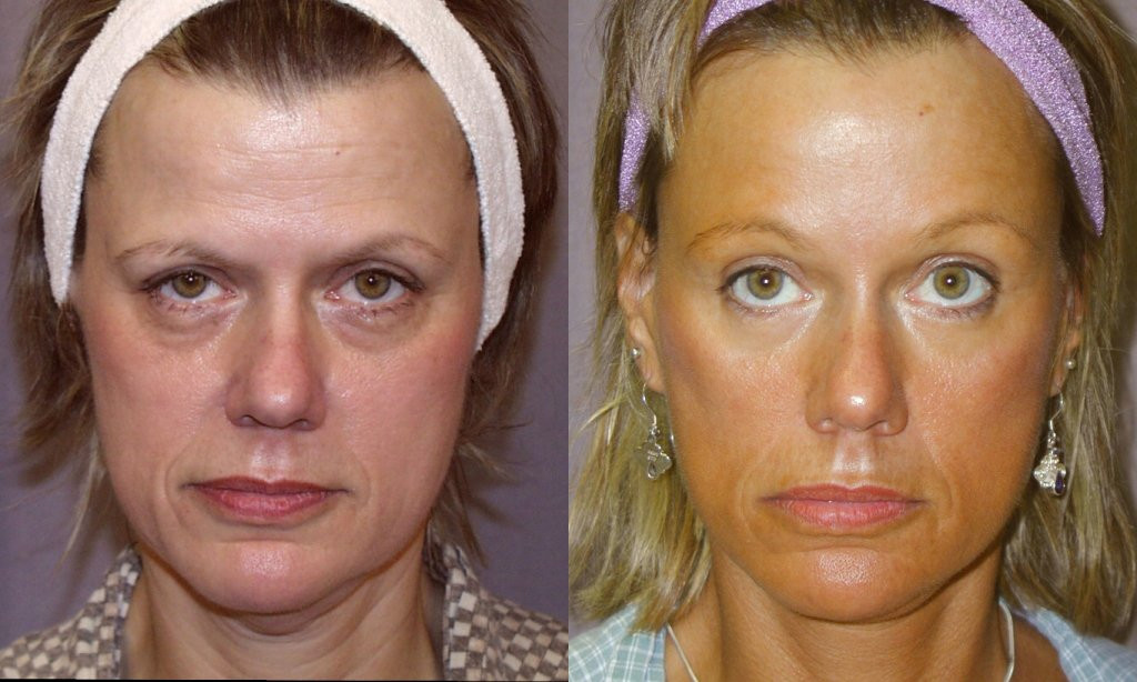Dr. Kirwan patient result. Facelift, 9 months post-op, front view Complete supplied comparison; before left, after right.