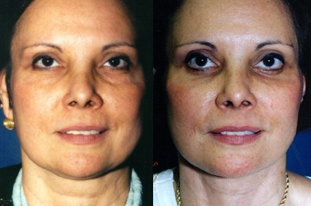 Dr. Kirwan patient result. Facelift with upper and lower eyelid surgery, 1 year post-op, front view. Combined-treatment result; visible changes cannot be attributed to one procedure alone. Complete supplied comparison; before left, after right.