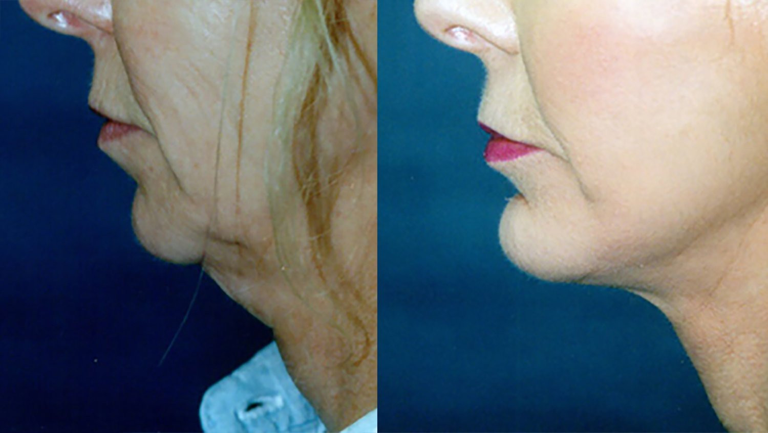 Dr. Kirwan patient result. Facelift with upper and lower eyelid surgery and perioral treatment, profile detail. Additional treatment details and follow-up interval are not established. Complete supplied comparison; before left, after right.