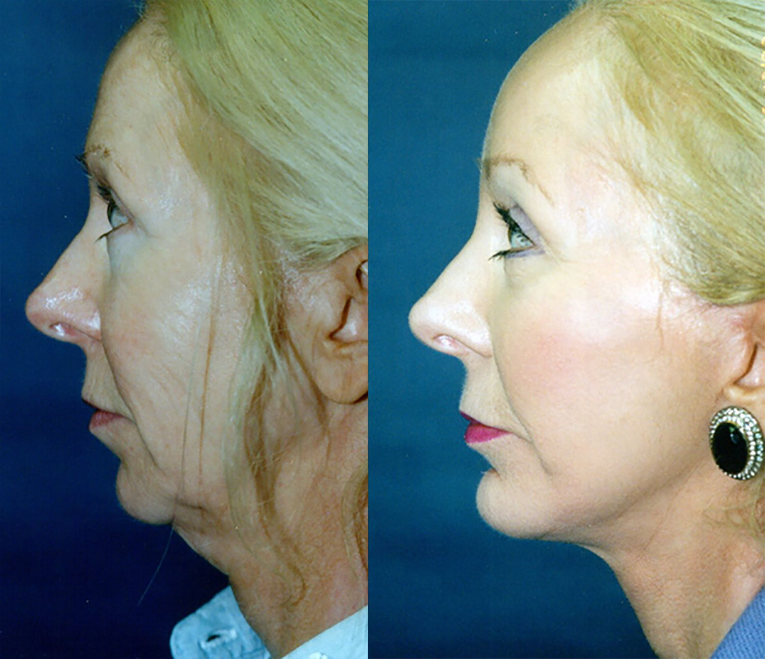 Dr. Kirwan patient result. Facelift with upper and lower eyelid surgery, perioral treatment and associated chin treatment, profile view. Exact chin treatment and follow-up interval are not established. Complete supplied comparison; before left, after right.