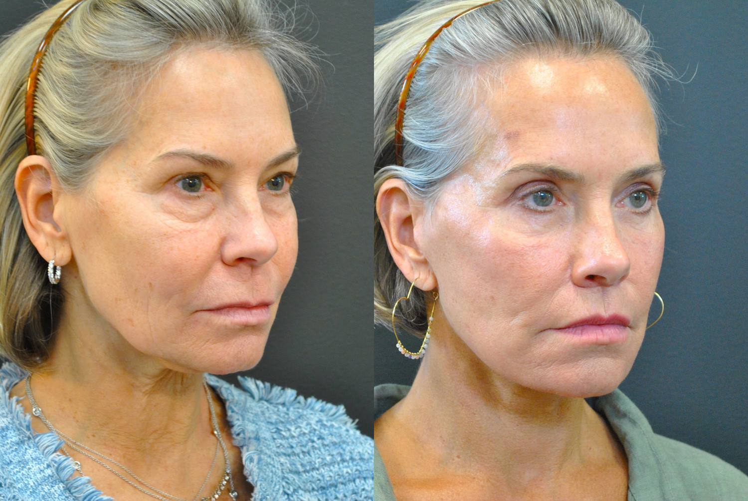 Dr. Kirwan patient result. Deep-plane facelift with upper-lip lift, 5 months post-op, oblique view. Additional treatment details are not established Complete supplied comparison; before left, after right.