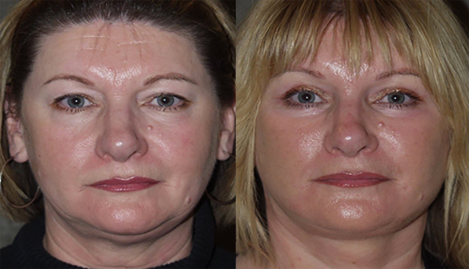 Dr. Kirwan patient result. Facelift with upper and lower eyelid surgery, 1 year post-op, front view. Combined-treatment result; visible changes cannot be attributed to one procedure alone. Complete supplied comparison; before left, after right.