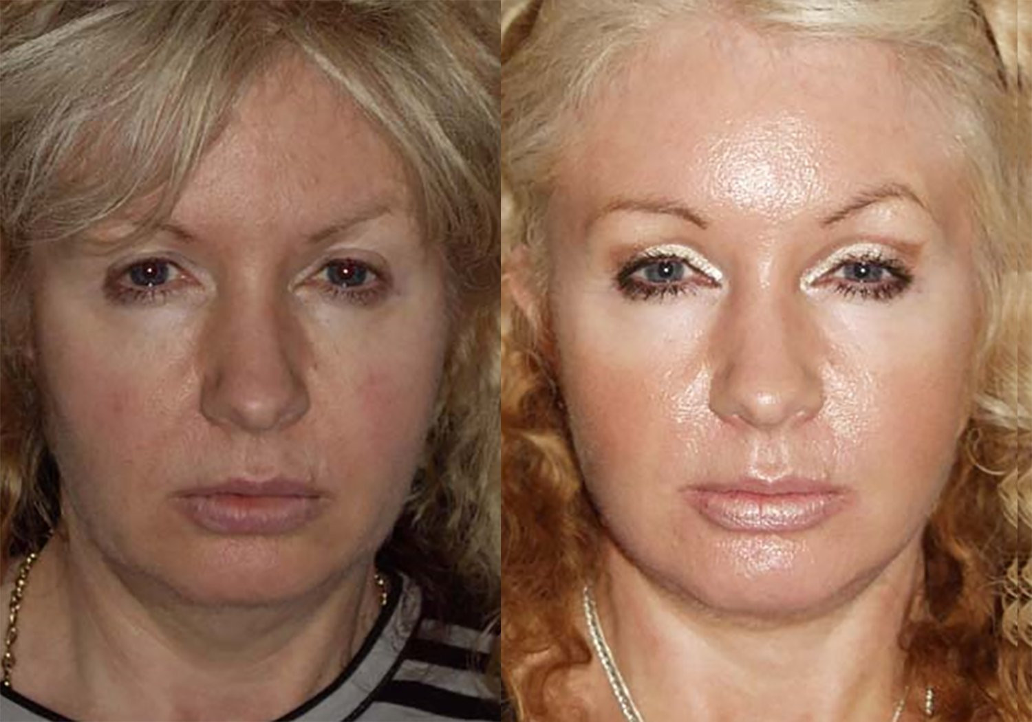 Dr. Kirwan patient result. Facelift with upper eyelid surgery, 1 year post-op. Source mentions an earlier facelift but does not establish its full interval. Combined-treatment result; visible changes cannot be attributed to one procedure alone. Complete supplied comparison; before left, after right.