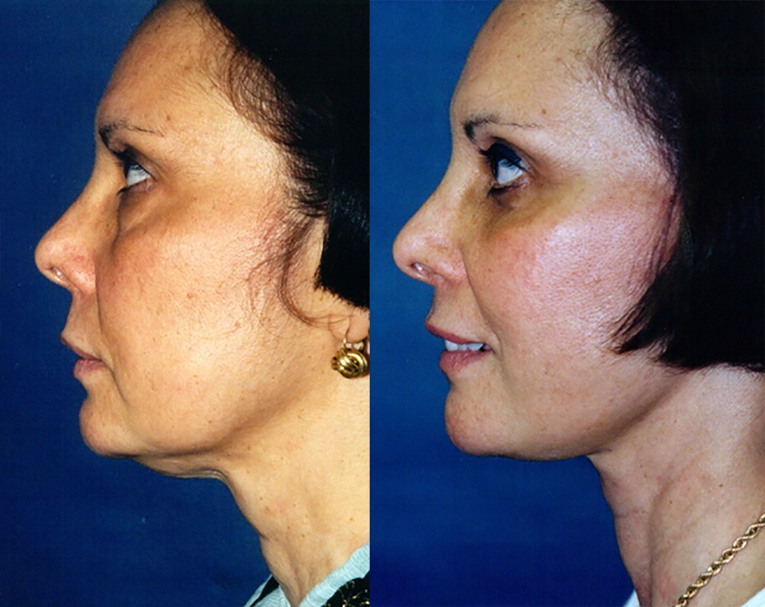 Dr. Kirwan patient result. Facelift with upper and lower eyelid surgery, 1 year post-op, profile view. Combined-treatment result; visible changes cannot be attributed to one procedure alone. Complete supplied comparison; before left, after right.