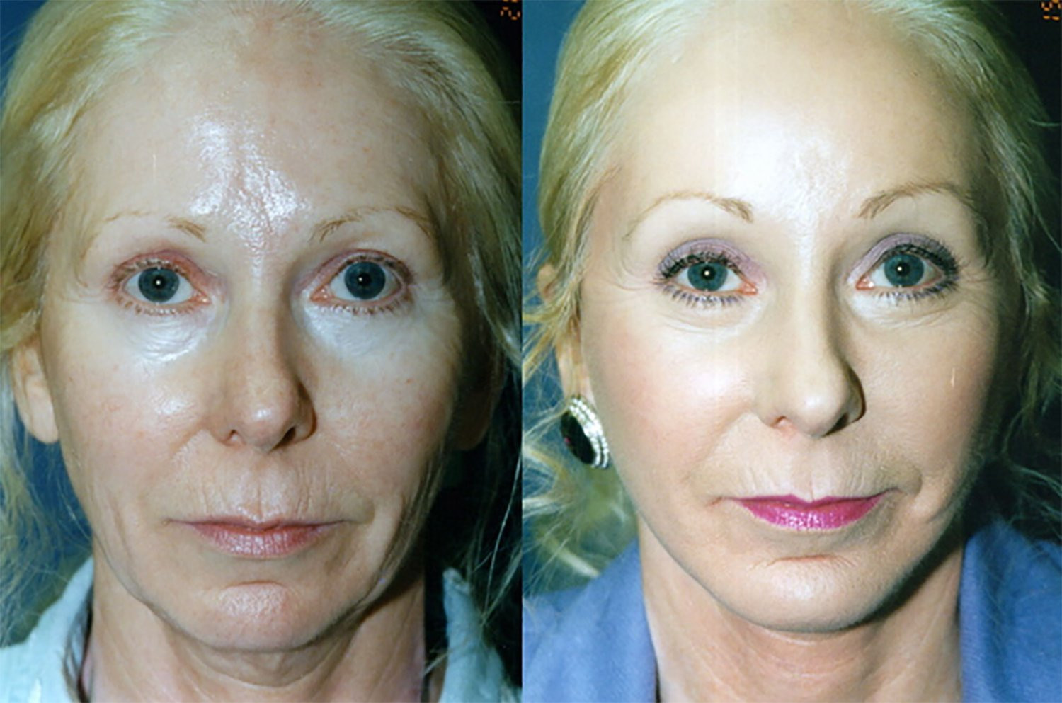 Dr. Kirwan patient result. Facelift with upper and lower eyelid surgery, perioral treatment and associated chin treatment, front view. Exact chin treatment and follow-up interval are not established. Complete supplied comparison; before left, after right.