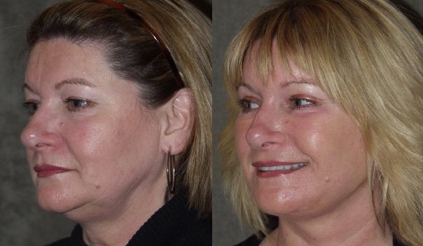 Dr. Kirwan patient result. Facelift with upper and lower eyelid surgery, 1 year post-op, oblique view. Combined-treatment result; visible changes cannot be attributed to one procedure alone. Complete supplied comparison; before left, after right.