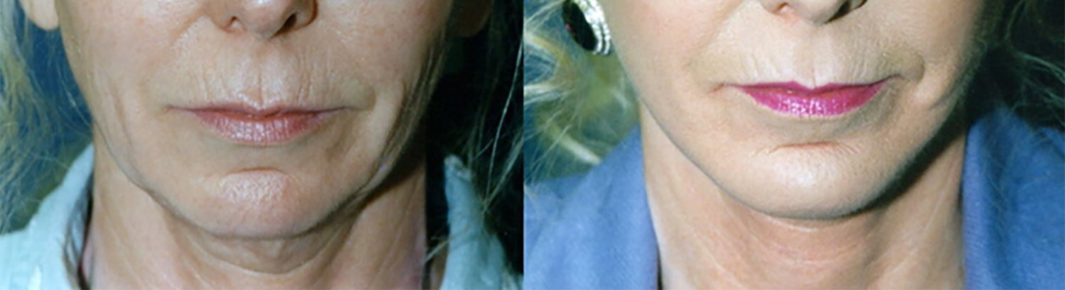 Dr. Kirwan patient result. Facelift with upper and lower eyelid surgery and perioral treatment, front detail. Follow-up interval and additional treatment details are not established Complete supplied comparison; before left, after right.