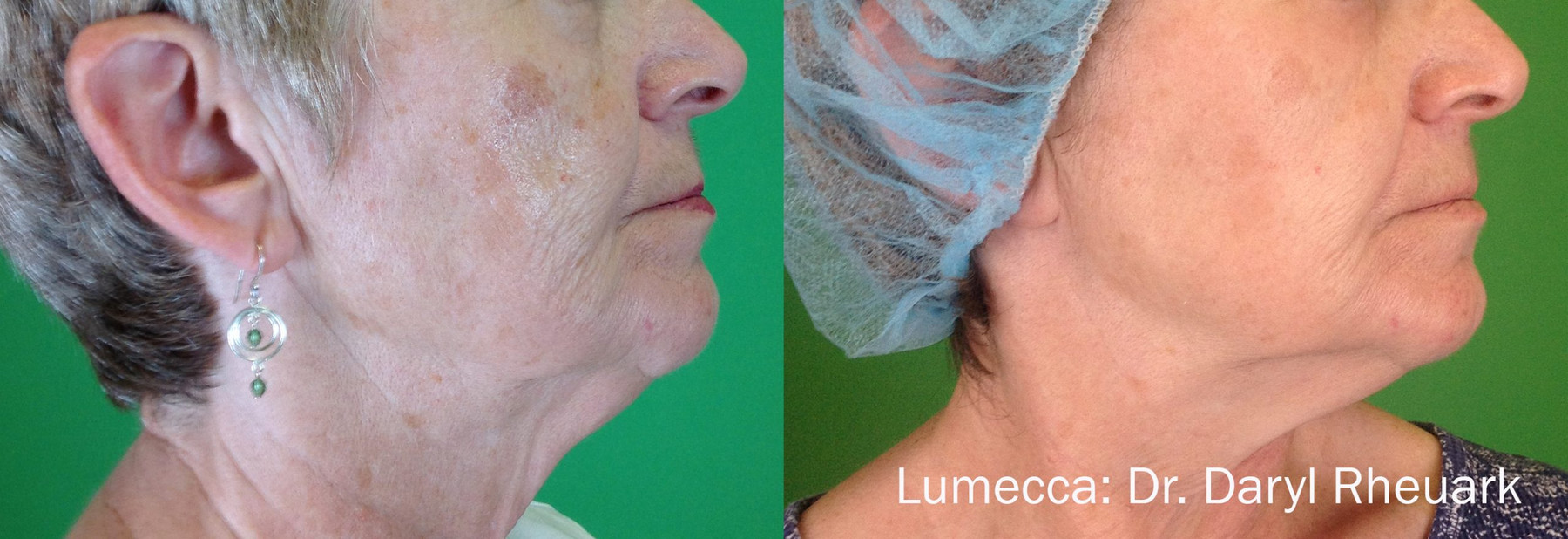 External treatment example — Dr. Daryl Rheuark. Lumecca, facial skin comparison; follow-up interval not supplied. Before: left; After: right.