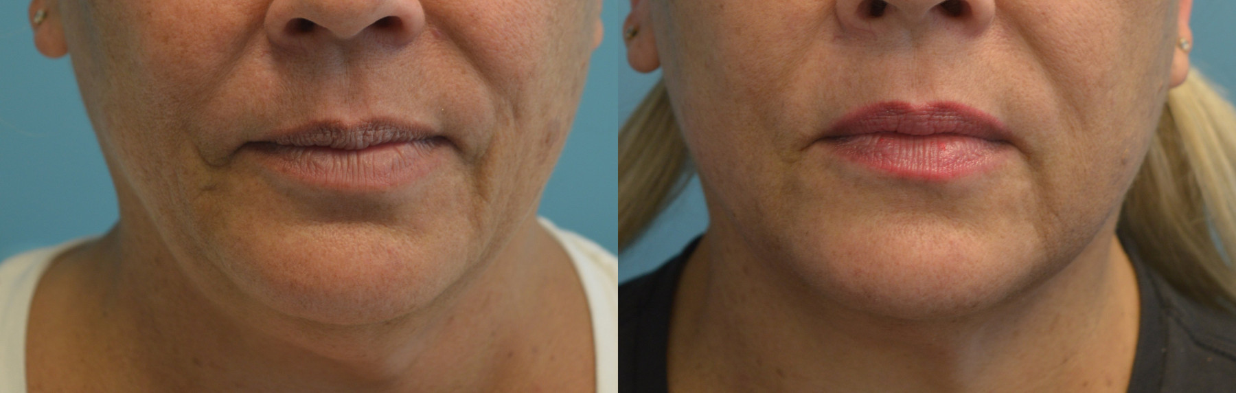 Dr. Kirwan patient result — Dr. Laurence Kirwan. FaceTite with liposuction and Morpheus8 to neck and jowls, supplied 1-month early follow-up, front crop. Combined-treatment result; visible changes cannot be attributed to one procedure alone.. Before: left; After: right.