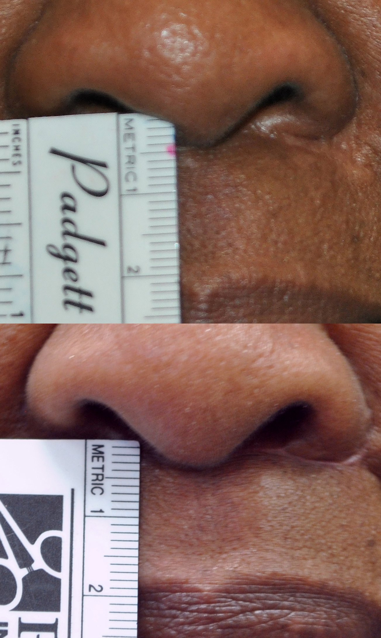 Dr. Kirwan patient result — Dr. Laurence Kirwan. Upper-lip shortening, ruler comparison, supplied 7-week early follow-up. Different scales and framing do not measure a precise change. Before: top; After: bottom.