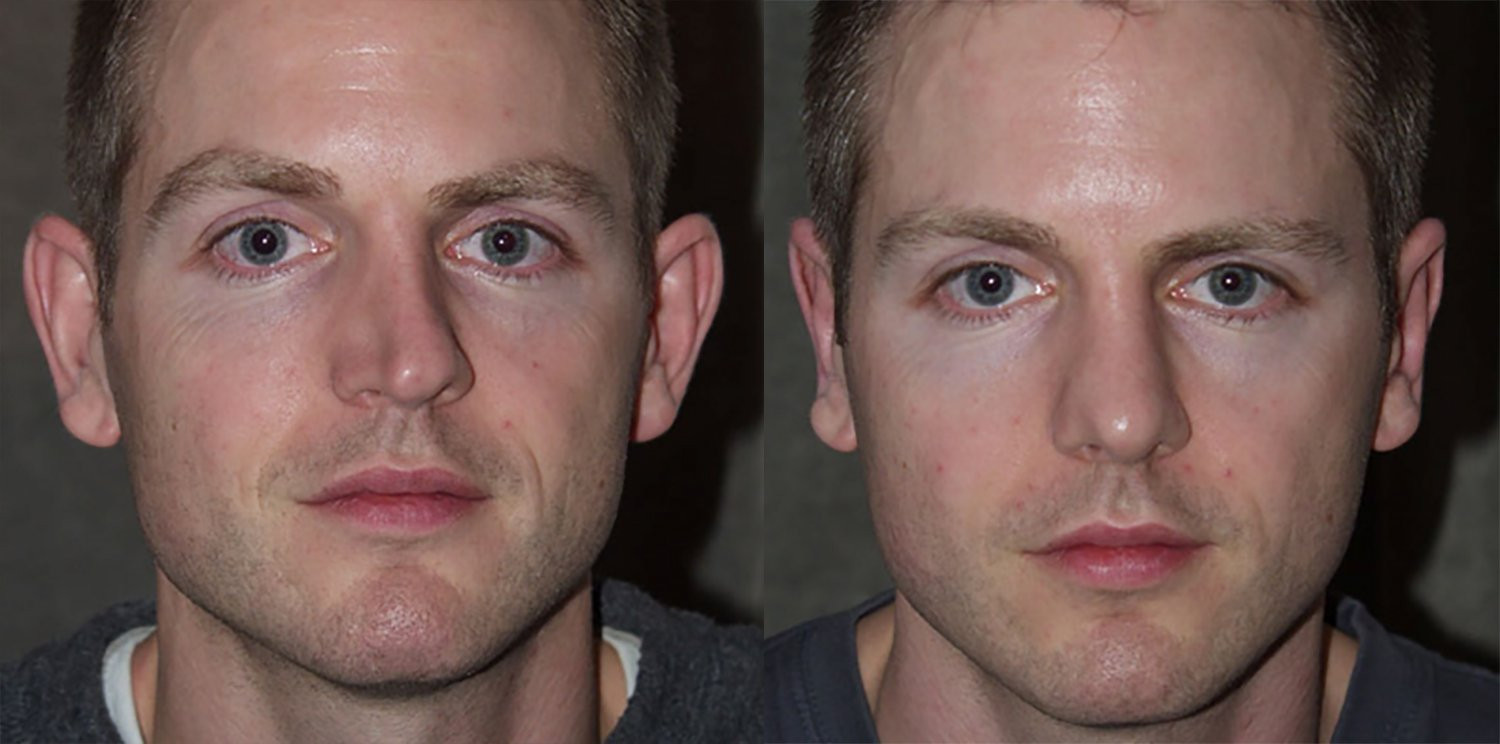 Dr. Kirwan patient result — Dr. Laurence Kirwan. Otoplasty combined with rhinoplasty, front view; follow-up interval not supplied. Before: left; After: right.