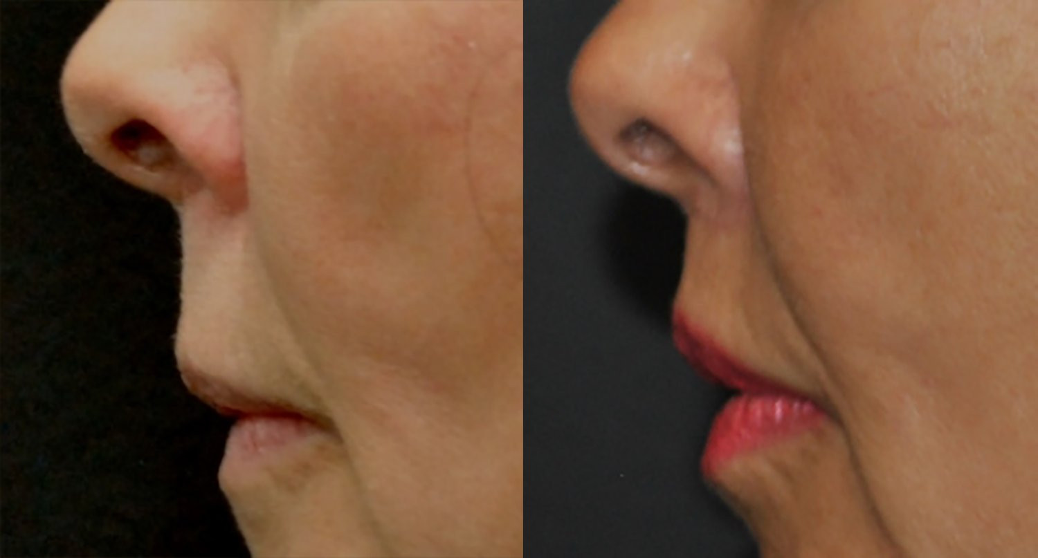 Dr. Kirwan patient result — Dr. Laurence Kirwan. Upper-lip lift with fat injection, 3 months post-op, profile detail. Additional treatment areas are not established. Before: left; After: right.