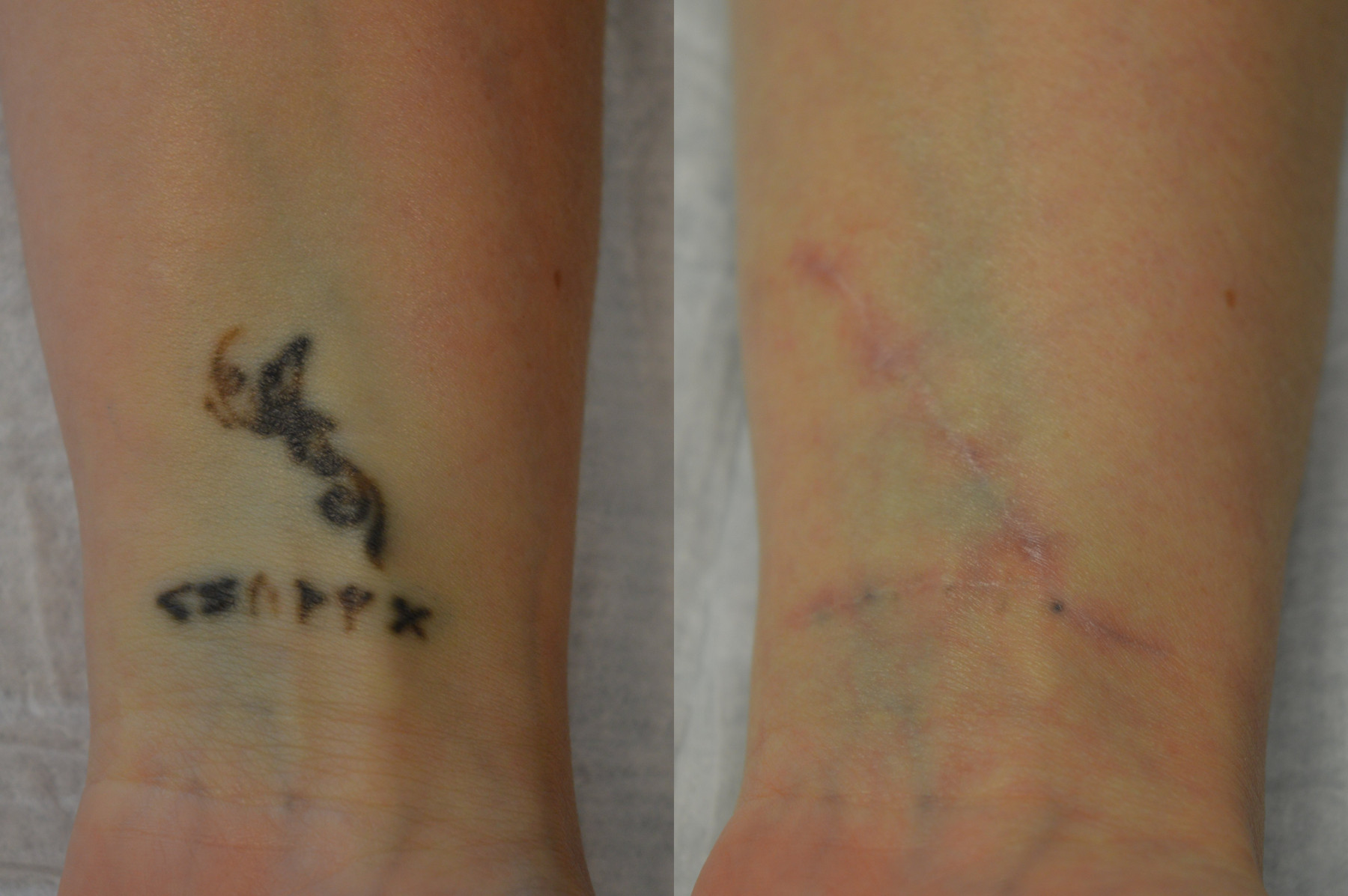 Dr. Kirwan patient result — Dr. Laurence Kirwan. Surgical tattoo excision, wrist comparison. A postoperative scar is visible; follow-up interval not supplied. Before: left; After: right.
