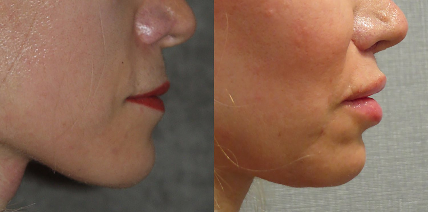 Dr. Kirwan patient result — Dr. Laurence Kirwan. Upper-lip shortening, 8 months post-op, profile view. Before: left; After: right.
