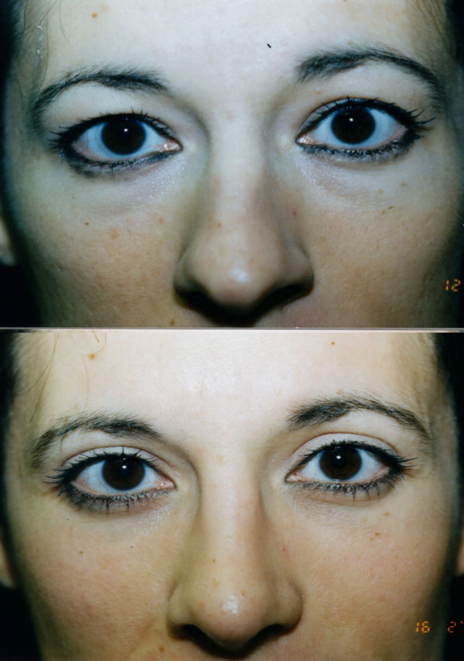 Dr. Kirwan patient result — Dr. Laurence Kirwan. Transconjunctival lower blepharoplasty with rhinoplasty. Combined-treatment comparison; postoperative interval not documented. Before: top; After: bottom.