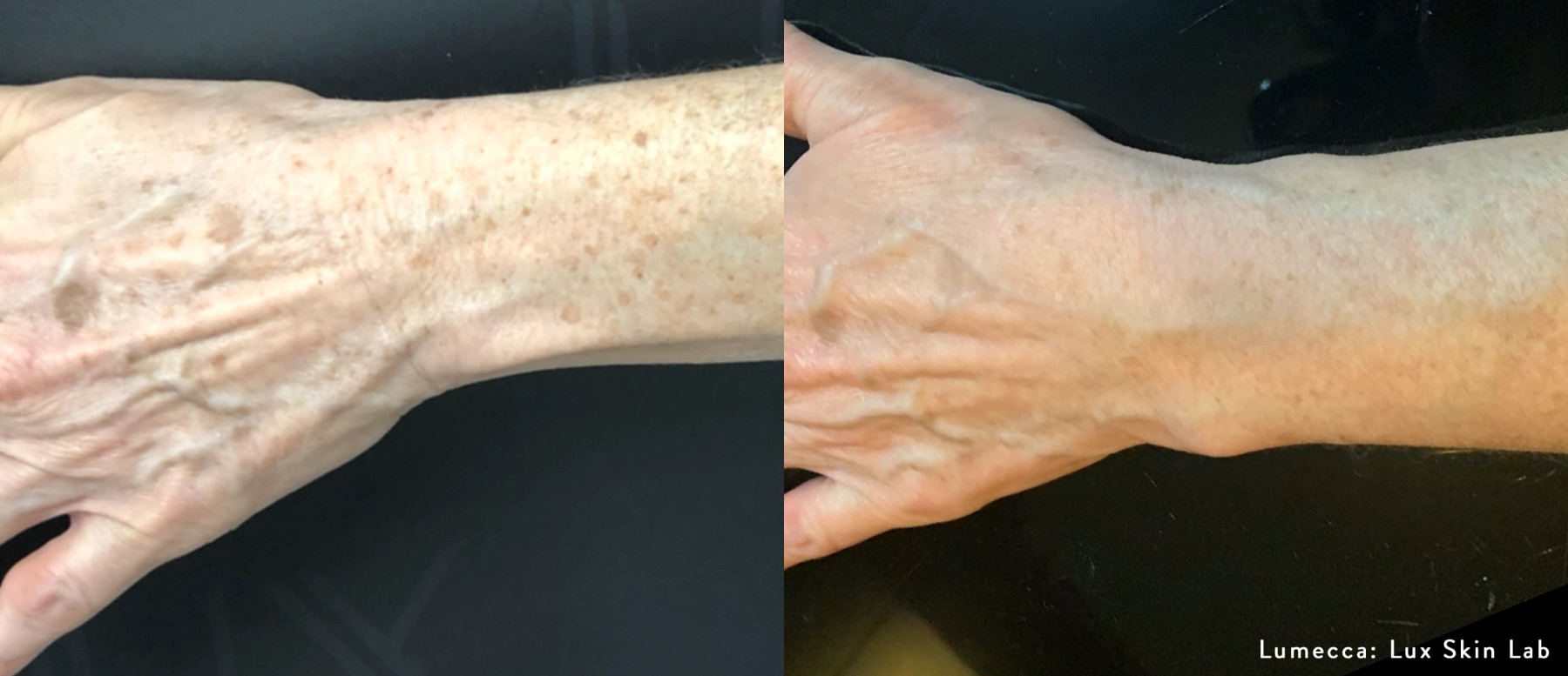 External treatment example — Lux Skin Lab. Lumecca, hand comparison; follow-up interval not supplied. Before: left; After: right.