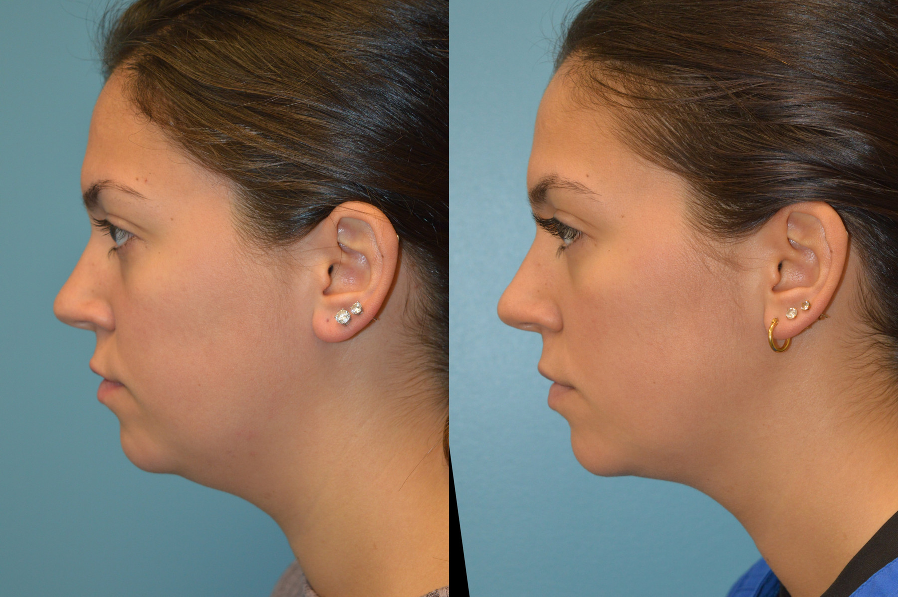 Dr. Kirwan patient result — Dr. Laurence Kirwan. AccuTite, profile view; follow-up interval not independently documented. Before: left; After: right.