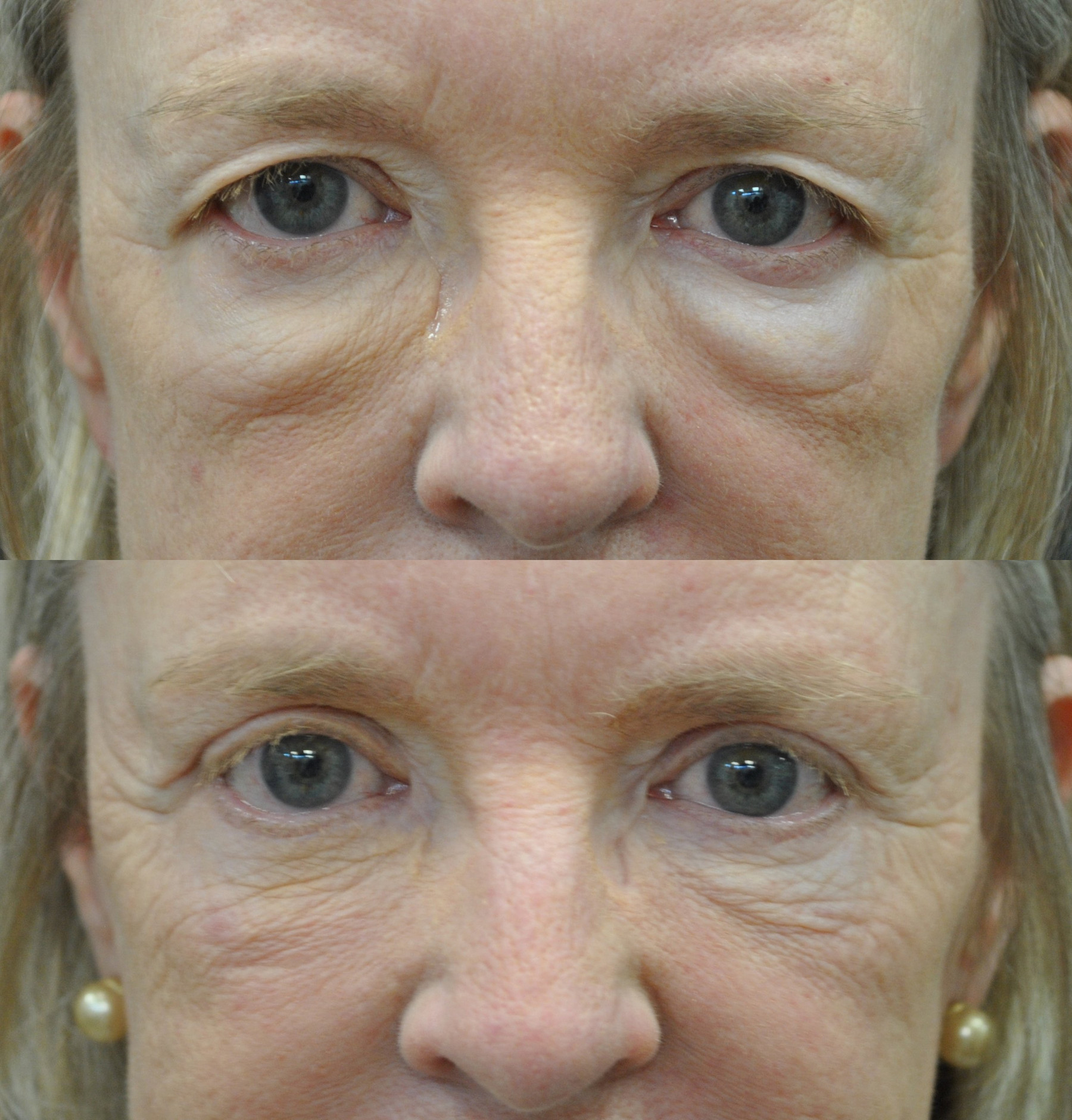 Dr. Kirwan patient result — Dr. Laurence Kirwan. Upper and lower blepharoplasty, forward-gaze comparison at six months. Before: top; 6 months after: bottom.