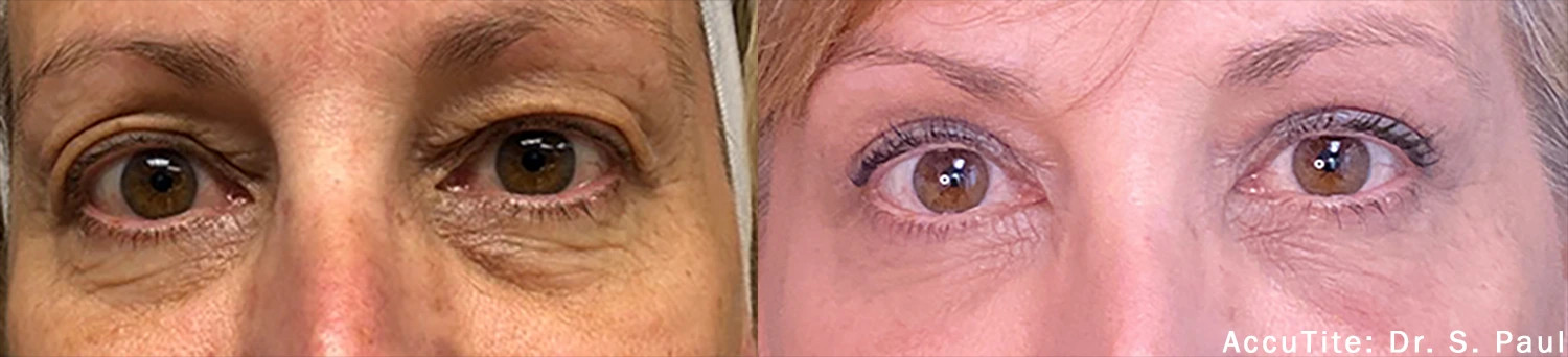 External treatment example — Dr. S. Paul. AccuTite, periorbital comparison; follow-up interval not supplied. Before: left; After: right.