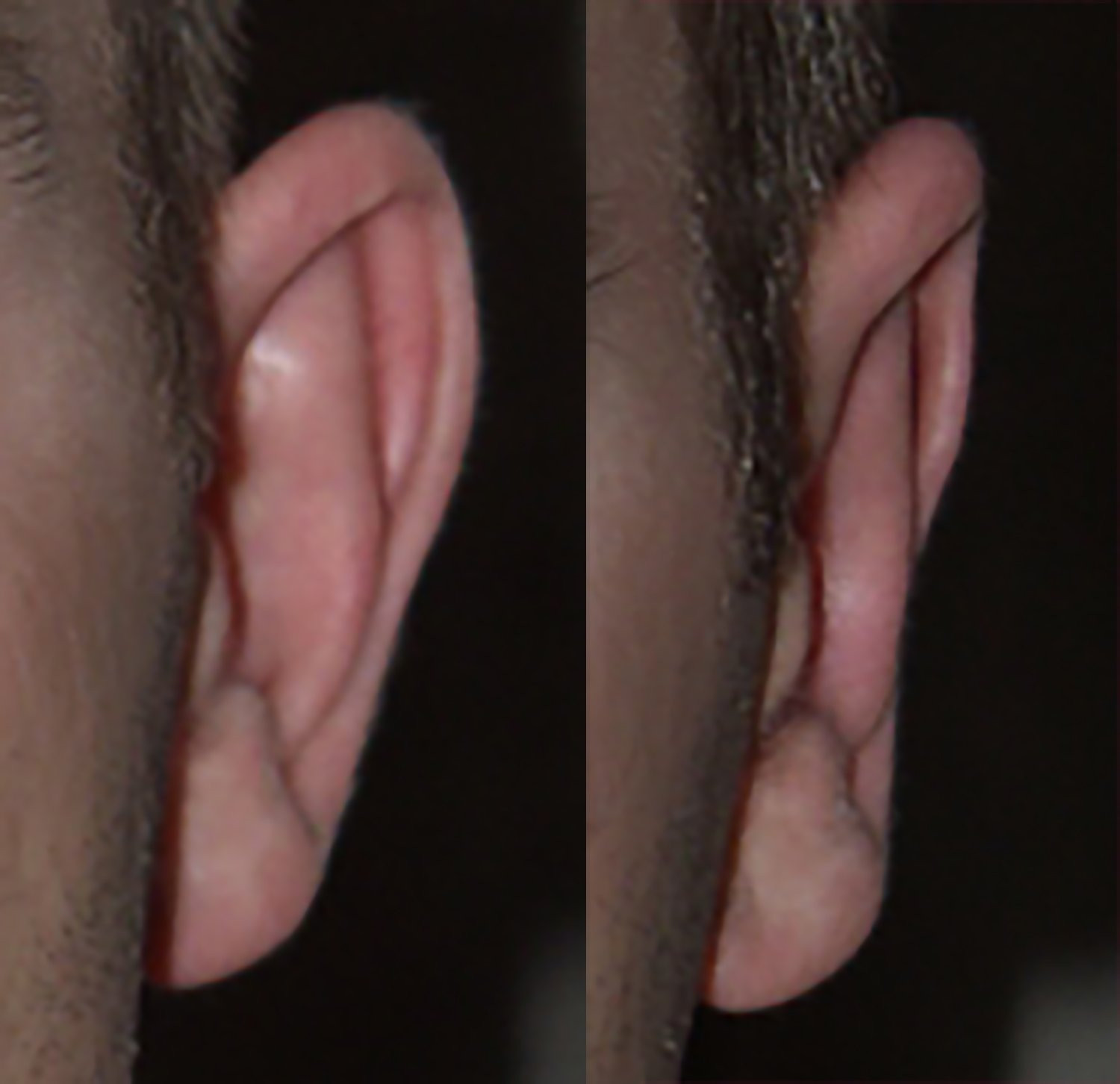 Dr. Kirwan patient result — Dr. Laurence Kirwan. Bilateral otoplasty, left ear view; follow-up interval not supplied. Before: left; After: right.