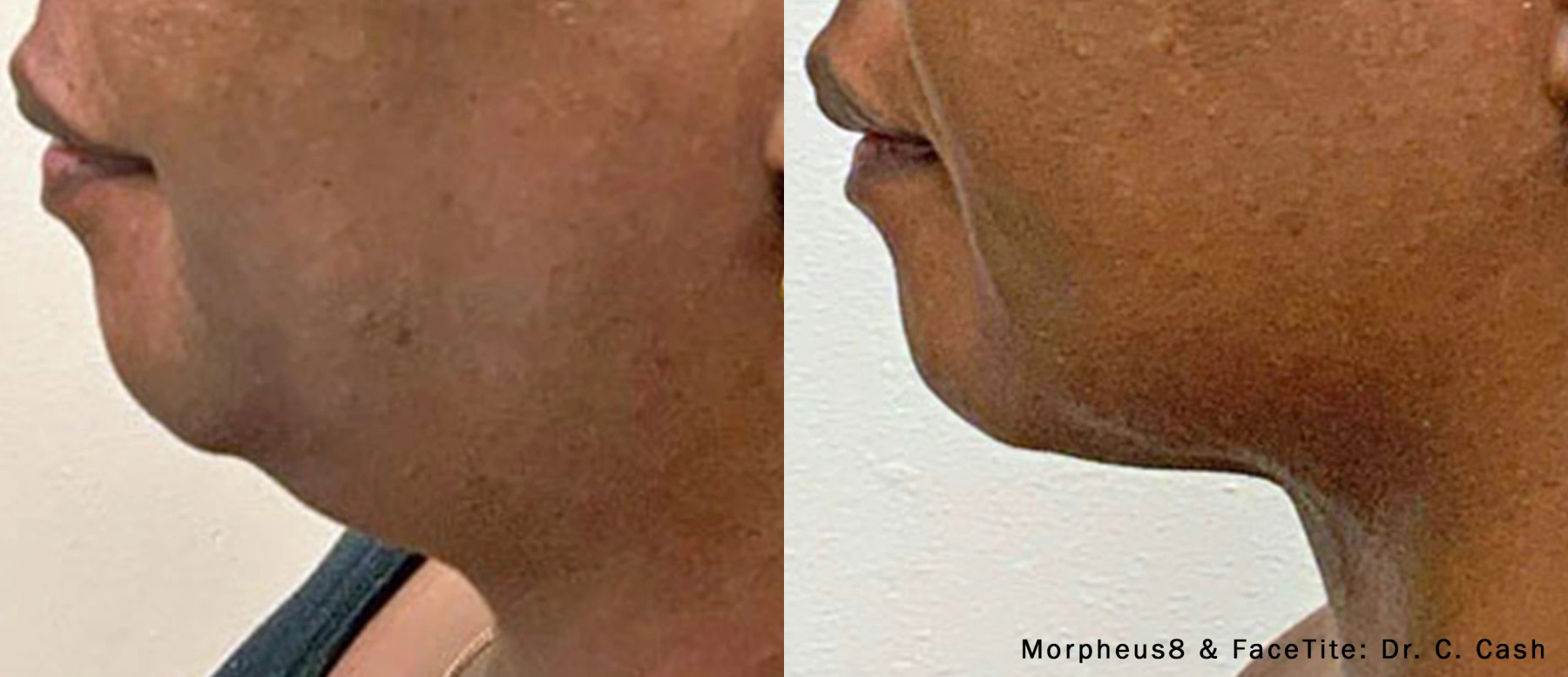 External treatment example — Dr. C. Cash. Morpheus8 with FaceTite, chin/neck profile. Combined-treatment changes cannot be attributed to either treatment alone. Before: left; After: right.