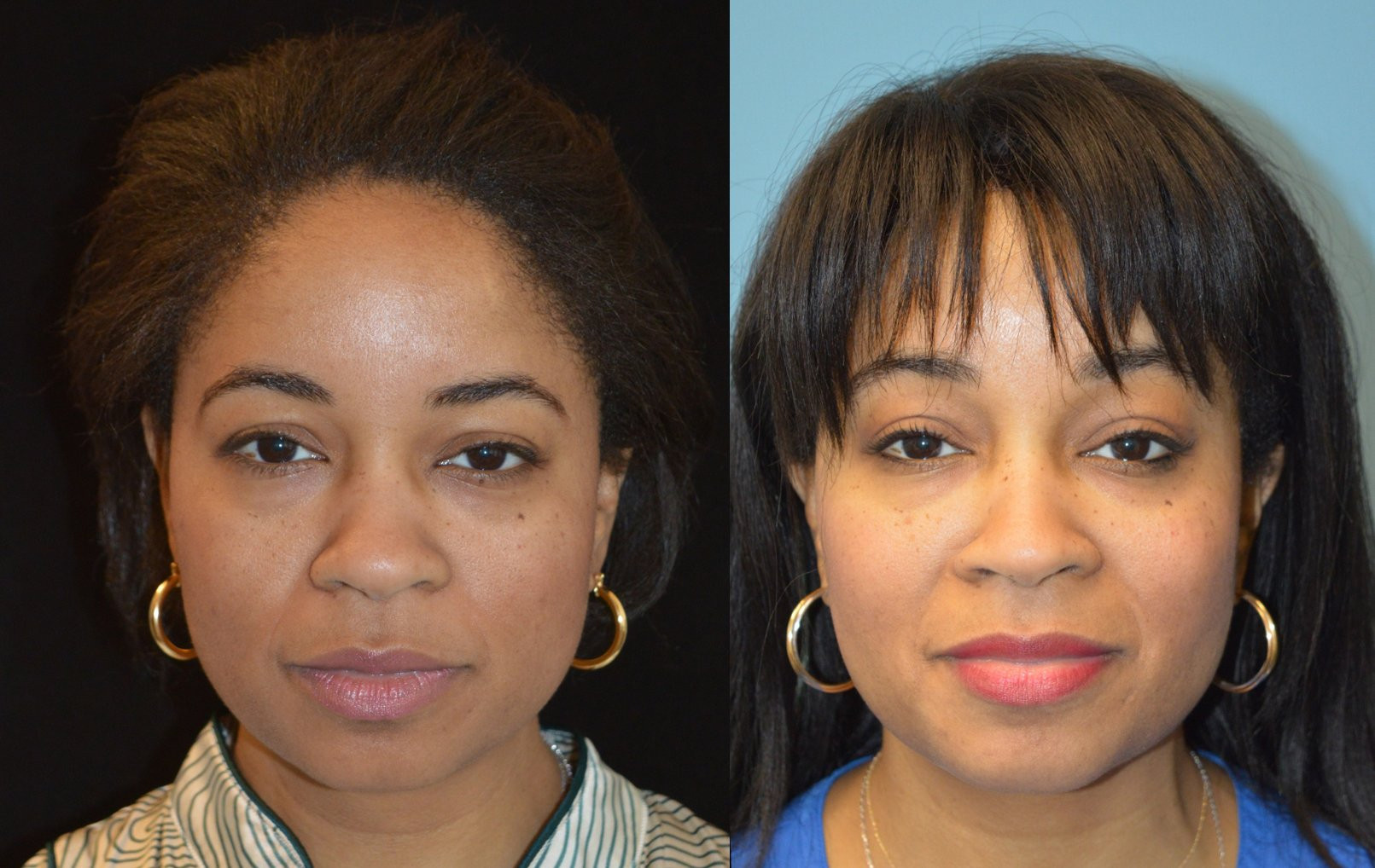 Dr. Kirwan patient result — Dr. Laurence Kirwan. 42-year-old, 16 months after endoscopic brow lift and buccal fat removal. Combined-treatment comparison; changes cannot be attributed to either procedure alone. Before: left; After: right.