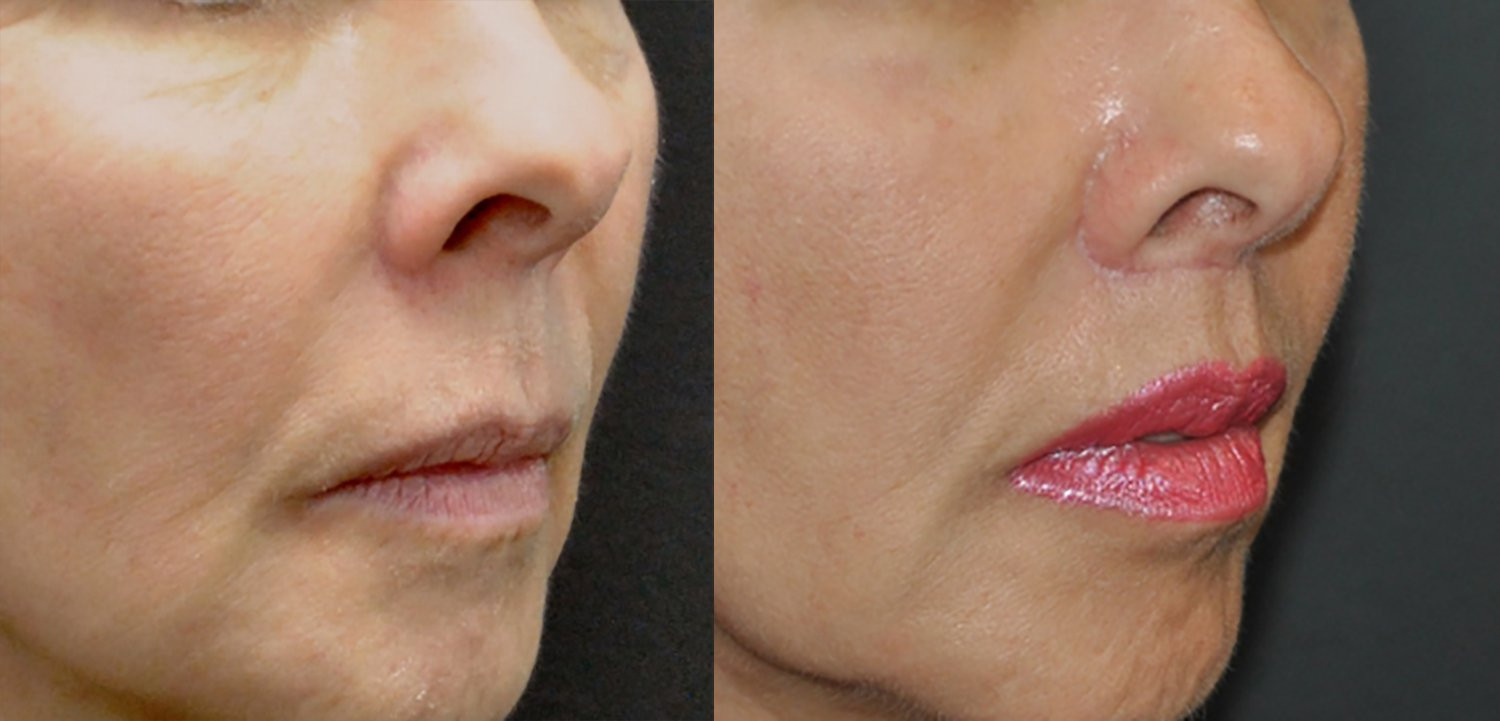Dr. Kirwan patient result — Dr. Laurence Kirwan. Upper-lip lift with fat injection, 3 months post-op, oblique detail. Additional treatment areas are not established. Before: left; After: right.