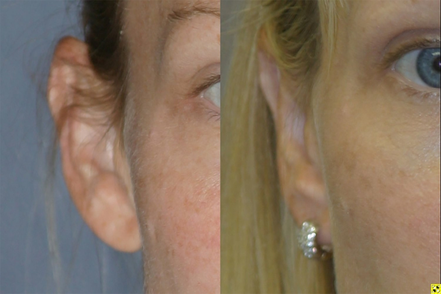 Dr. Kirwan patient result — Dr. Laurence Kirwan. Bilateral otoplasty, supplied 2-year follow-up, right ear view. Before: left; After: right.