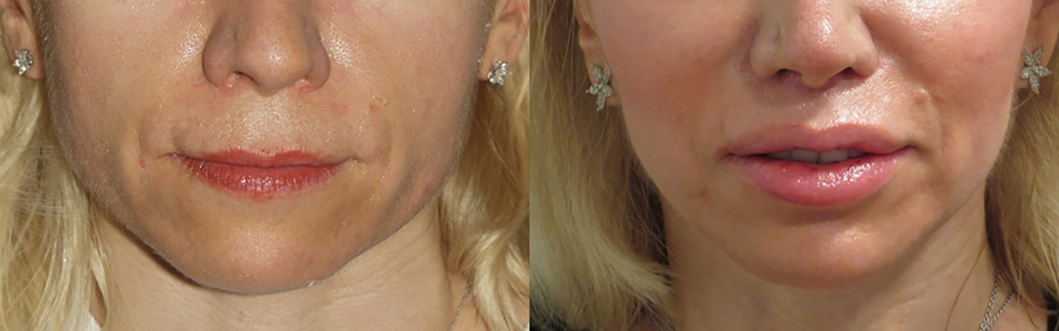 Dr. Kirwan patient result — Dr. Laurence Kirwan. Upper-lip shortening with chin and cheek implants, front detail. Combined-treatment changes cannot be attributed to lip surgery alone; follow-up interval not supplied. Before: left; After: right.