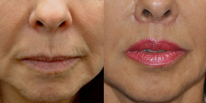 Dr. Kirwan patient result — Dr. Laurence Kirwan. Upper-lip lift with fat injection, 3 months post-op, front detail. Additional treatment areas are not established. Before: left; After: right.