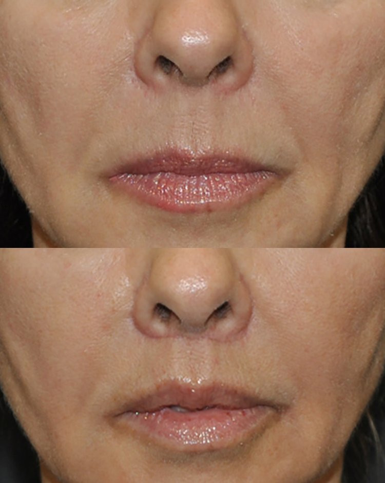 Dr. Kirwan patient result — Dr. Laurence Kirwan. Upper-lip lift with fat injection, 6-week early follow-up, front detail. Additional treatment areas are not established. Before: top; After: bottom.