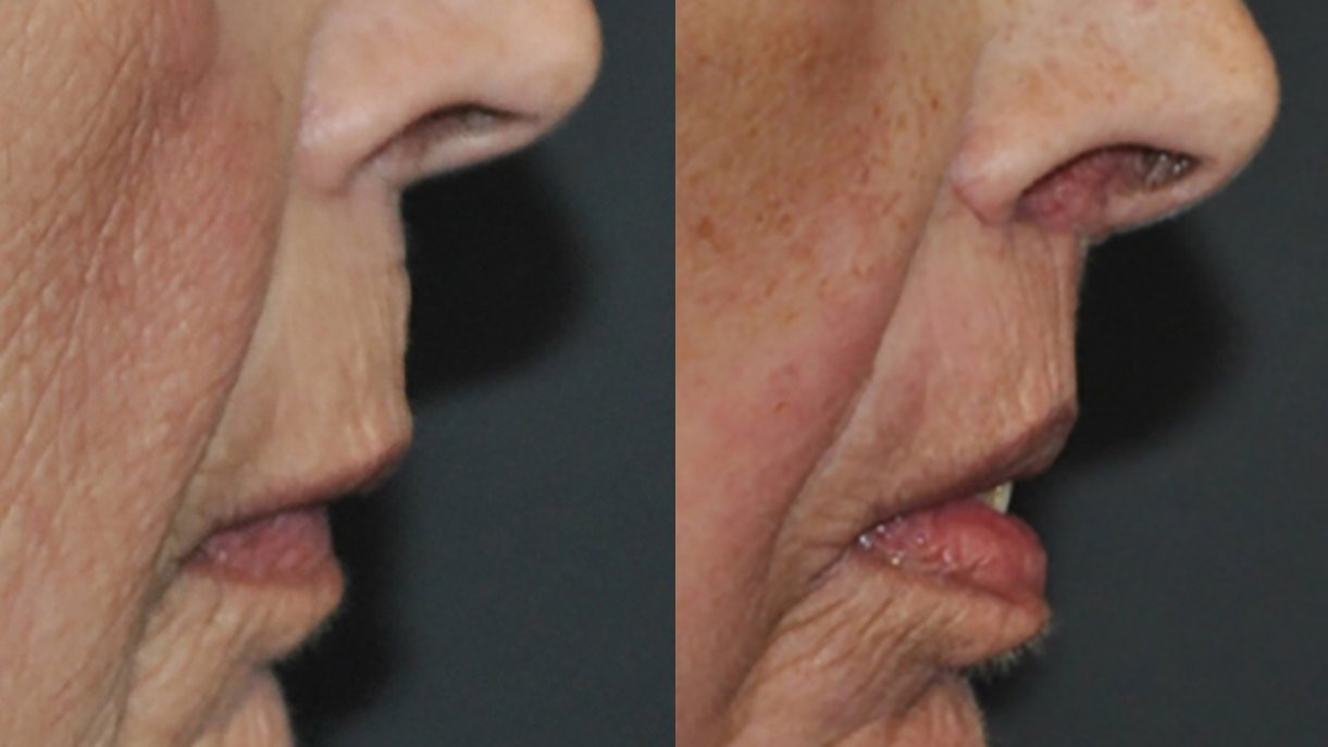 Dr. Kirwan patient result — Dr. Laurence Kirwan. Upper-lip lift with fat injection, 6-week early follow-up, profile detail. Additional treatment areas are not established. Before: left; After: right.