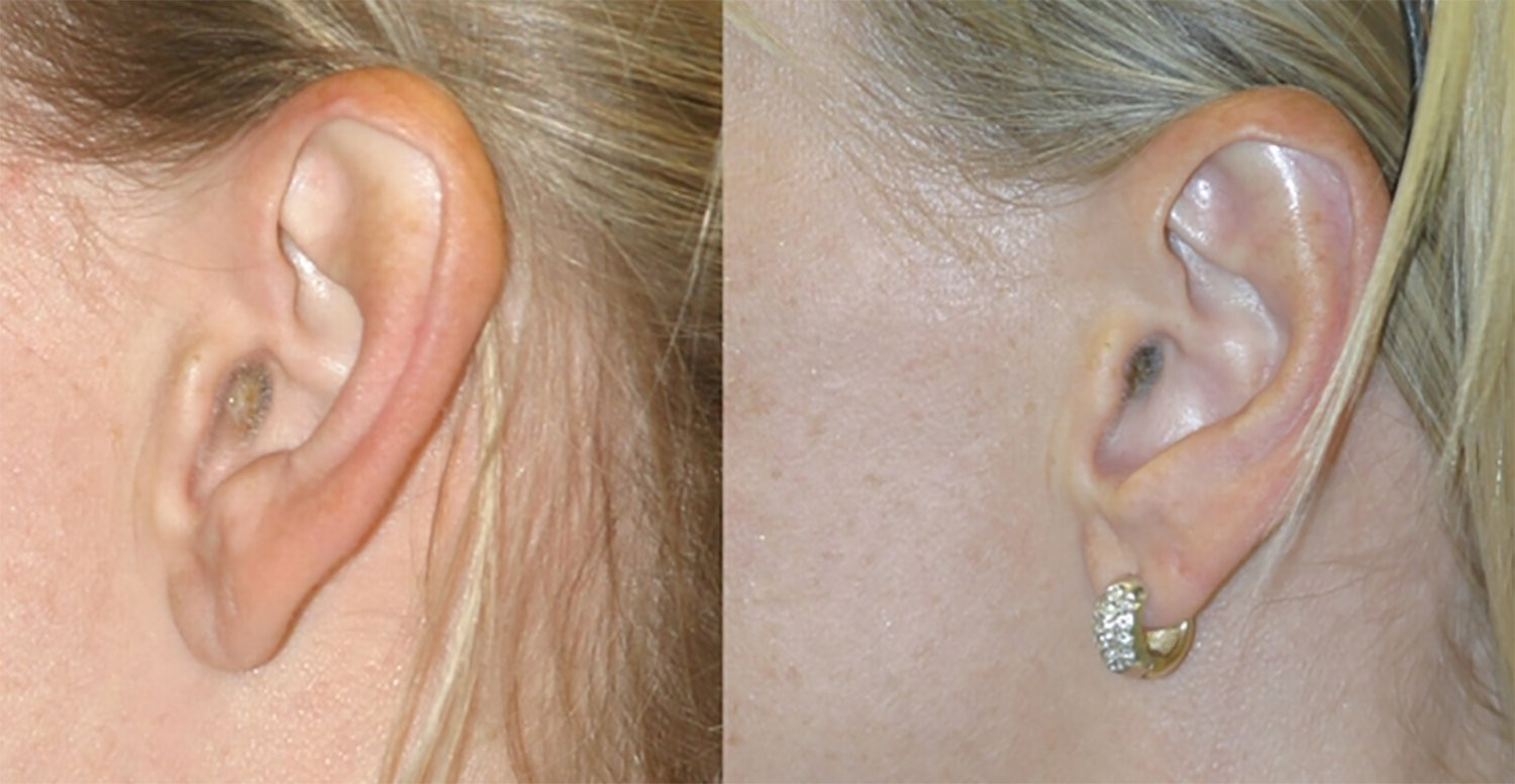Dr. Kirwan patient result — Dr. Laurence Kirwan. Bilateral otoplasty, supplied 2-year follow-up, left ear view. Before: left; After: right.