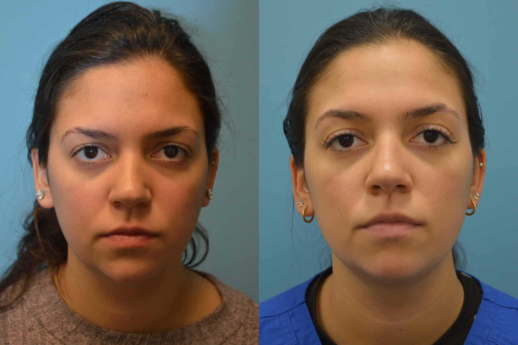 Dr. Kirwan patient result — Dr. Laurence Kirwan. AccuTite, front view; follow-up interval not independently documented. Before: left; After: right.