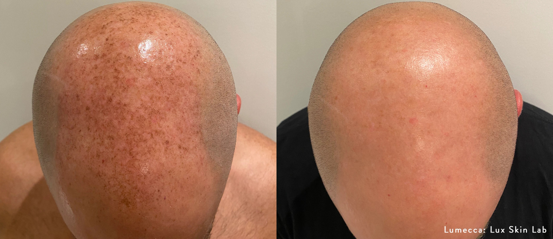 External treatment example — Lux Skin Lab. Lumecca, scalp comparison; follow-up interval not supplied. Before: left; After: right.