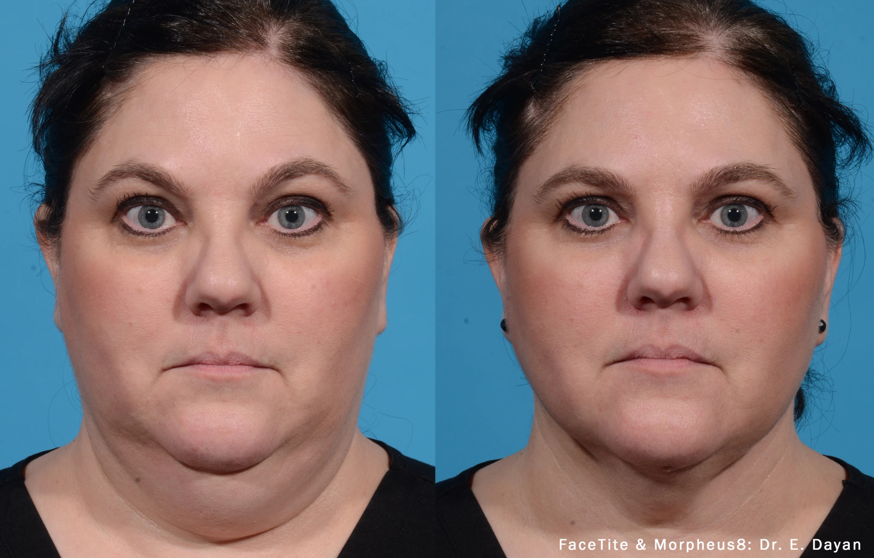 External treatment example — Dr. E. Dayan. FaceTite with Morpheus8, full-face front comparison. Combined-treatment changes cannot be attributed to either treatment alone. Before: left; After: right.