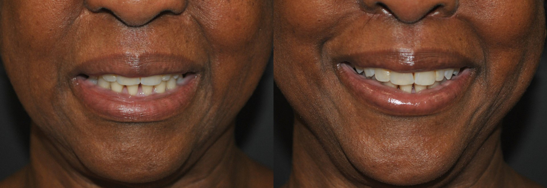 Dr. Kirwan patient result — Dr. Laurence Kirwan. Upper-lip shortening, smile comparison, supplied 7-week early follow-up. Before: left; After: right.