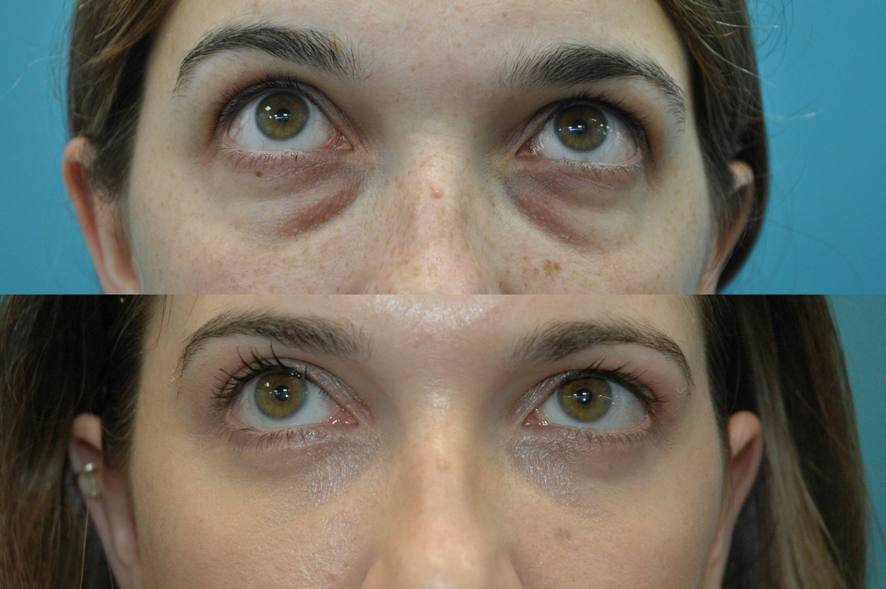 Dr. Kirwan patient result — Dr. Laurence Kirwan. Upper and lower blepharoplasty with fat pad transposition, upward gaze. Postoperative interval not documented. Before: top; After: bottom.