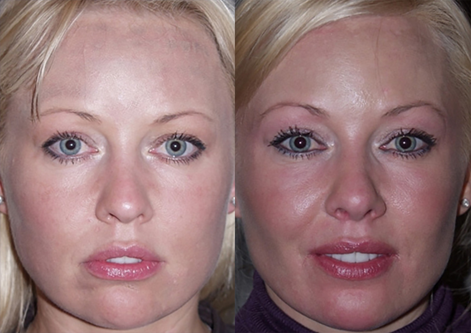 Dr. Kirwan patient result — Dr. Laurence Kirwan. Buccal fat removal, full-face comparison; follow-up interval not supplied. Before: left; After: right.