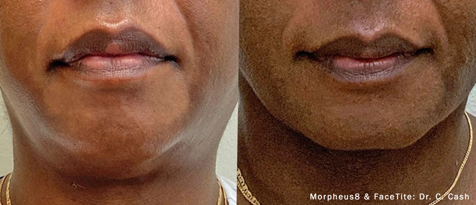 External treatment example — Dr. C. Cash. Morpheus8 with FaceTite, lower-face front view. Combined-treatment changes cannot be attributed to either treatment alone. Before: left; After: right.