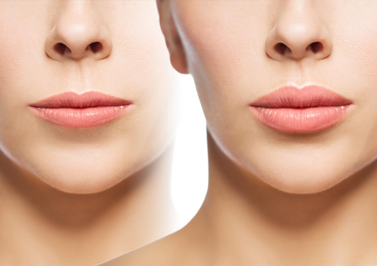 Woman before and after lip treatment