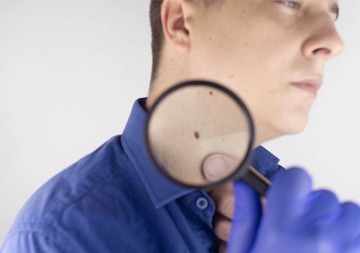 A man at a dermatologist appointment shows his birthmarks, moles and nevi