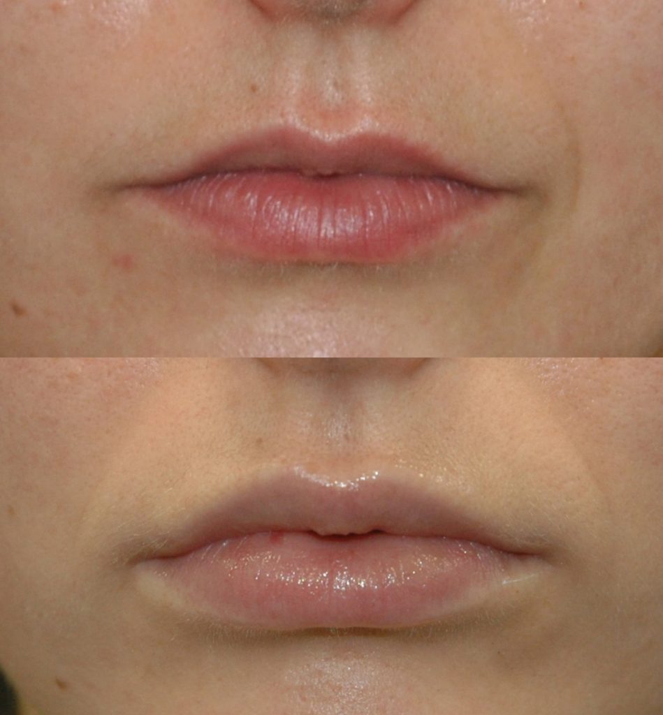23 year old lip flip Juvederm Ultra Plus upper and lower lips 5 days front mouth closed