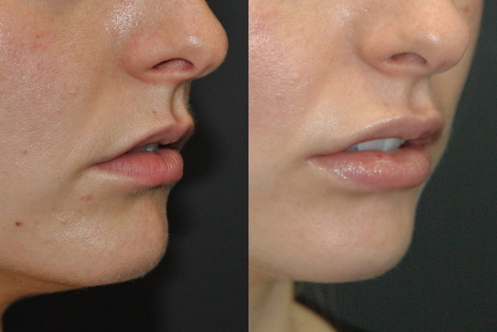 23-year-old-lip-flip-juvederm-Ultra-Plus-upper-and-lower-lips-5-days-lips-only-oblique