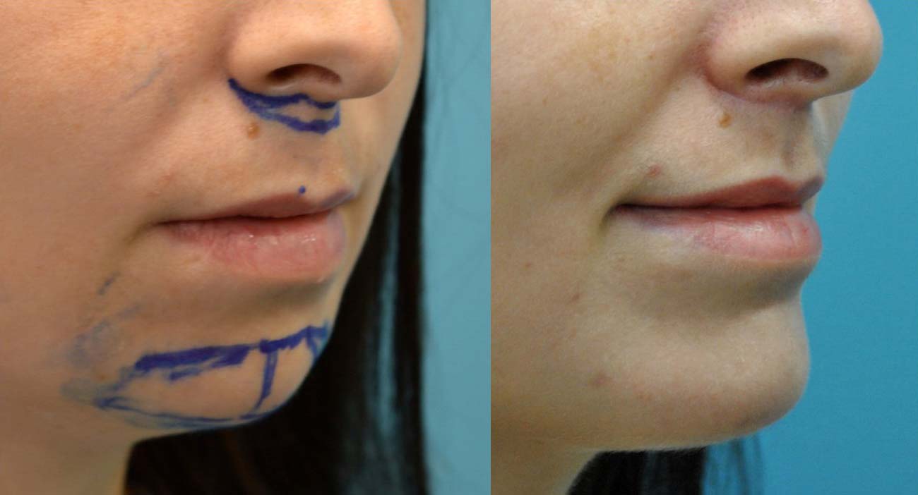 29 year old upper lip shortening with chin implant 3 months after surgery oblique view