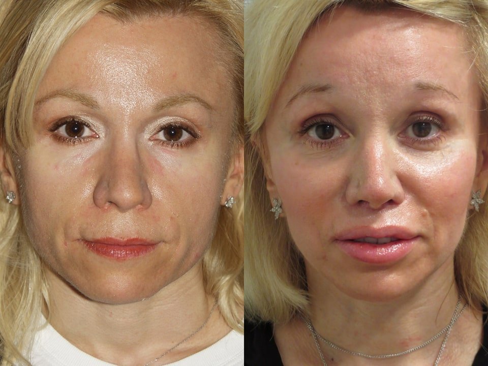 Upper lip shortening, chin and cheek augmentation and fat injection to face and lips in gap group patient.
