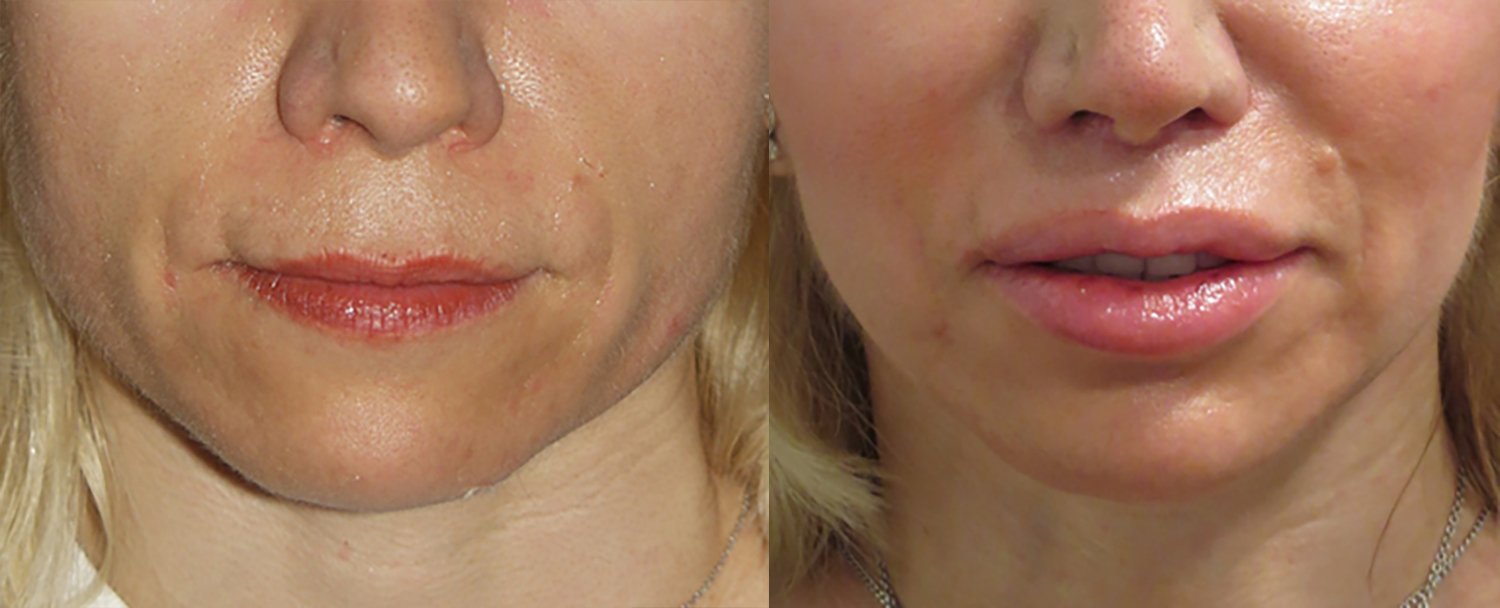 52-year old upper lip shortening, chin implants, fat injection lips and cheeks