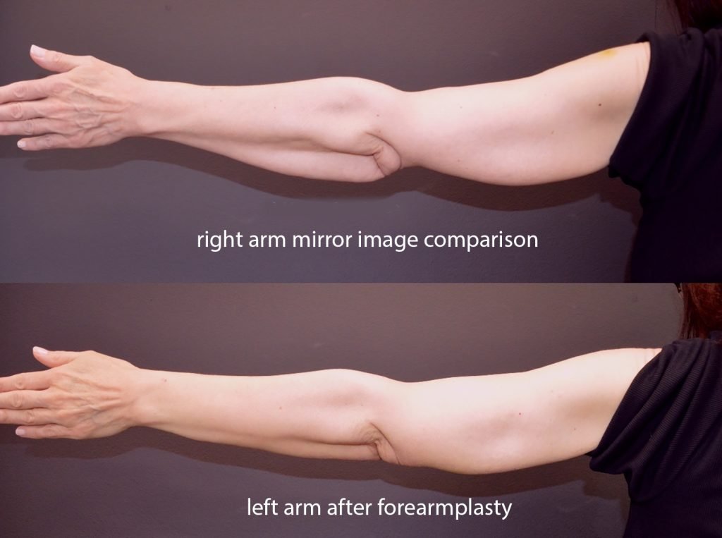 56-year-old 3 weeks after left forearmplasty (bottom)